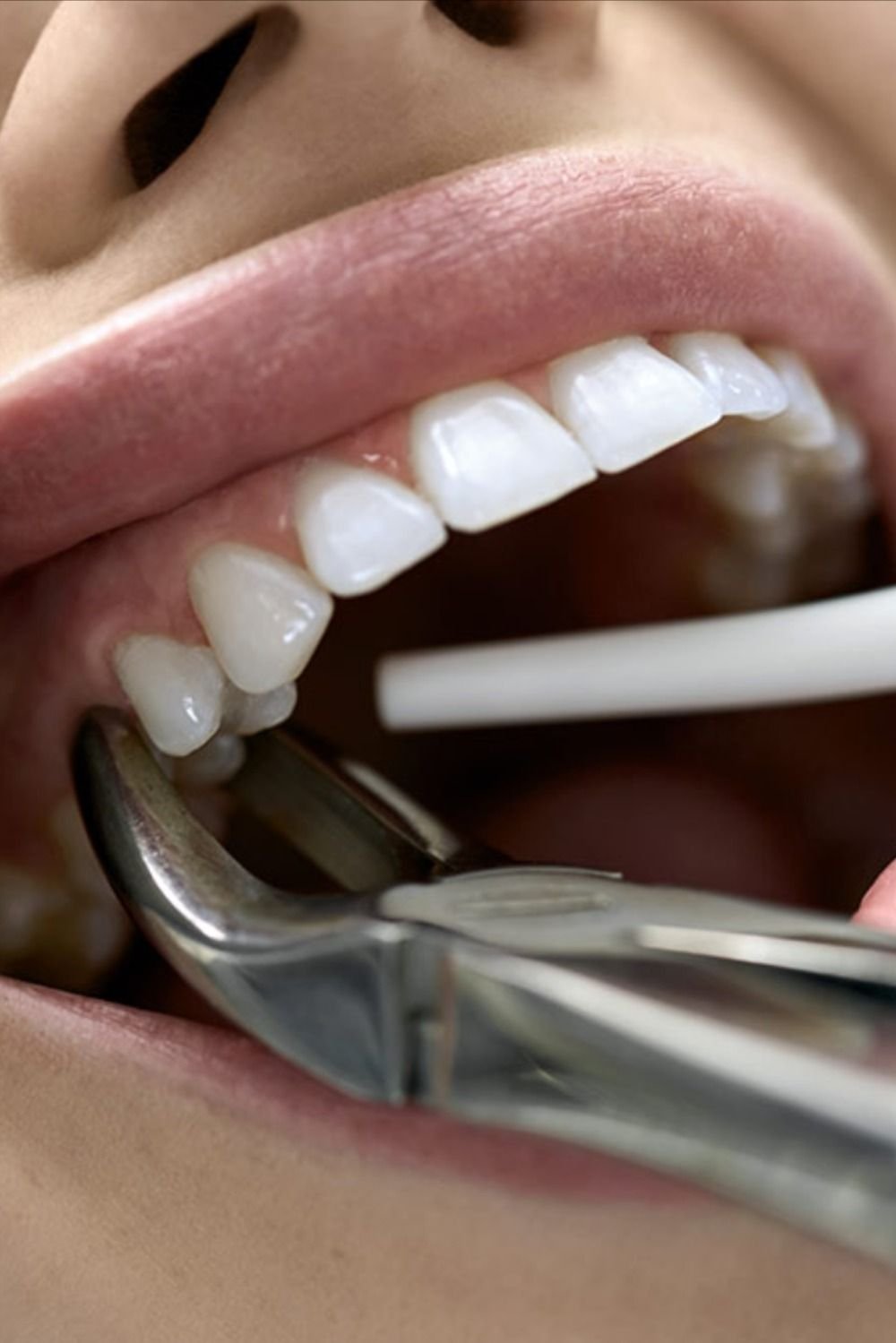 Tooth extraction treatment at Best Smilles
